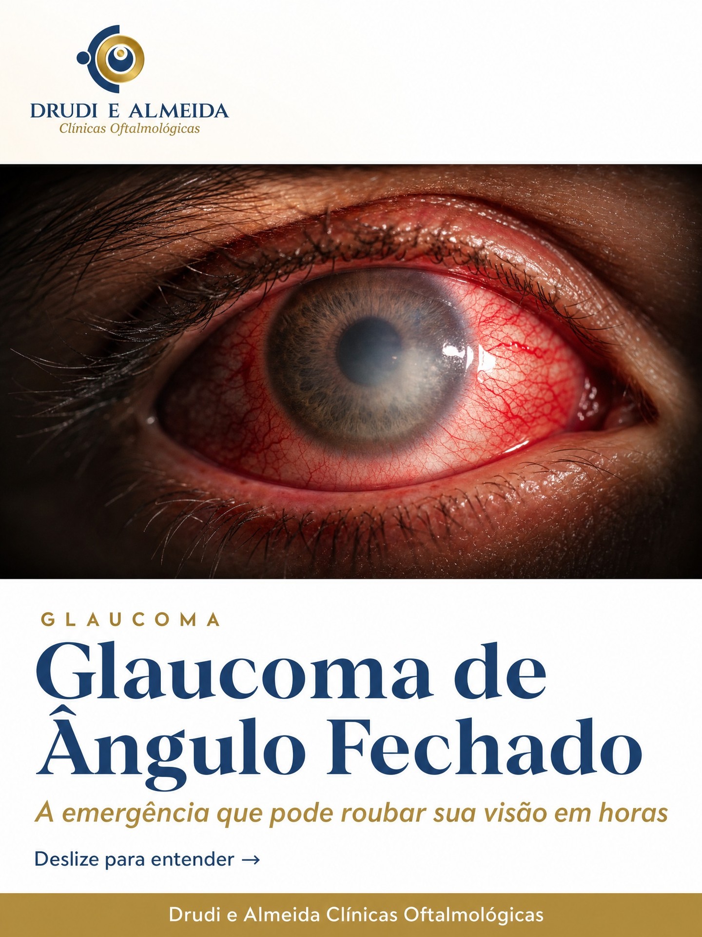 Carrossel: O glaucoma de ângulo fechado é uma das emergências oftalmológicas mais graves —
