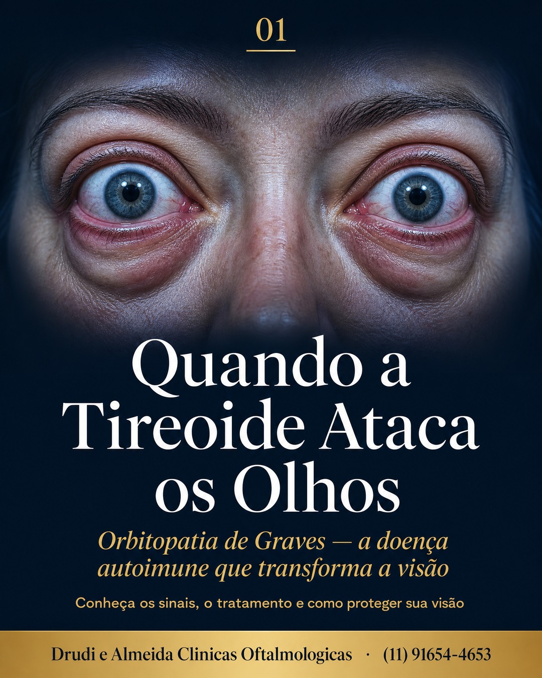 Carrossel: você sabia que a tireoide pode atacar os seus olhos?

A Orbitopatia de Graves e