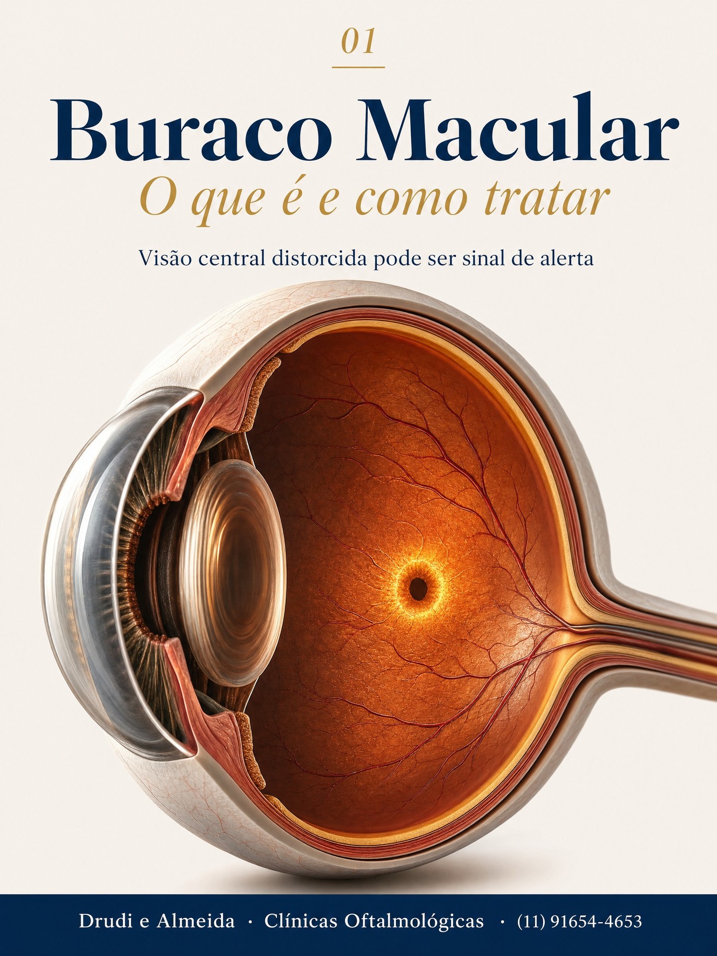 Carrossel: Buraco Macular: o que acontece quando a mácula tem um furo?

A mácula é a região