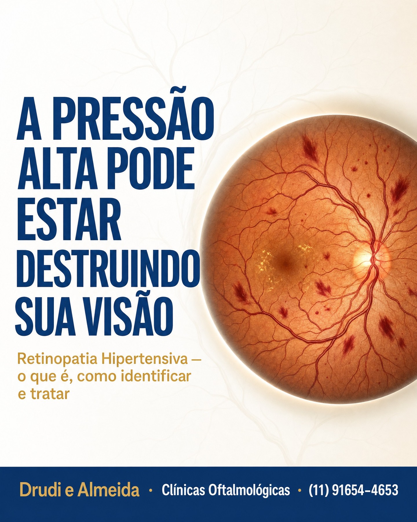 Carrossel: 🔴 A pressão alta pode estar destruindo sua visão — e você nem sabe.

A Retinopa