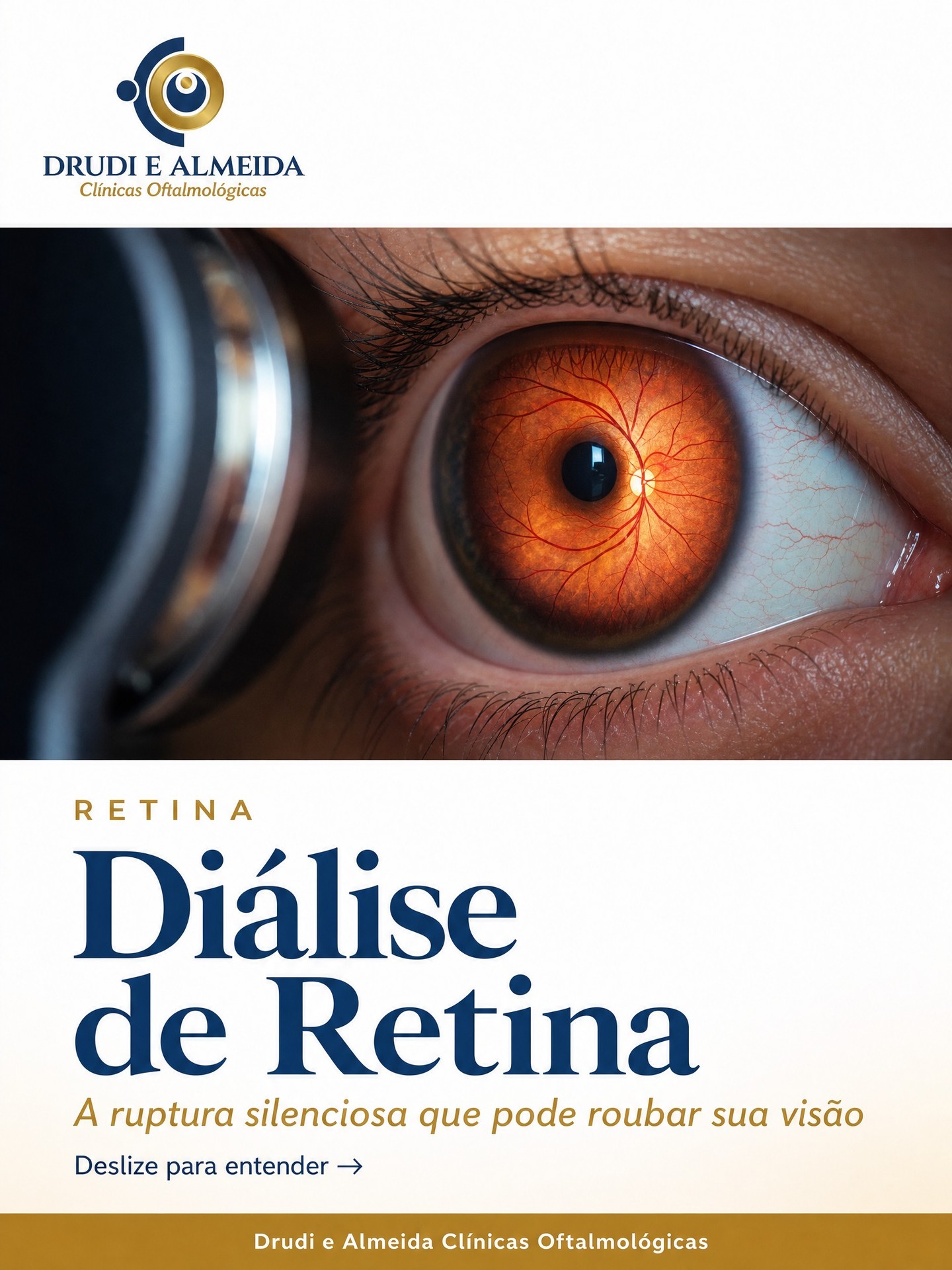 Carrossel: Você sabia que a diálise de retina pode evoluir em silêncio por meses ou até ano